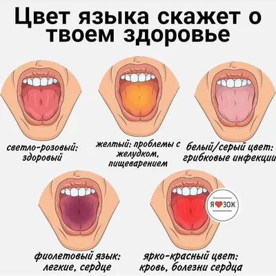 Рак языка и полости рта: причины, симптомы и лечение в статье онколога Опря  А. Н.