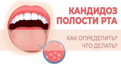 Налет на языке – причины, симптомы, лечение 👅 Как убрать белый налет на  языке 😛 | CIS