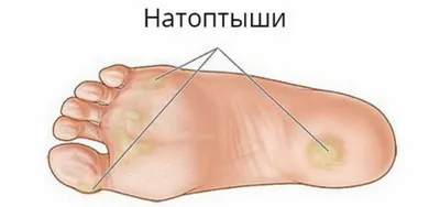 Боль в стопе [как лечить, причины и что делать когда болят ступни ног]