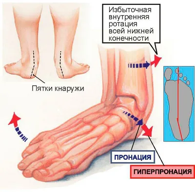 Медицинский плакат \"Деформация стопы\" - 1002234 - VR6185L - ZVR6185L -  Плакаты по опорно-двигательному аппарату человека - 3B Scientific