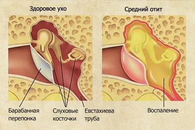 Наружный отит - причины, симптомы, диагностика и лечение