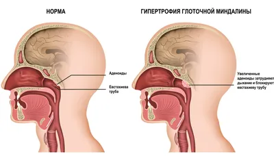 Удаление миндалин: показания, стоимость, восстановление после операции