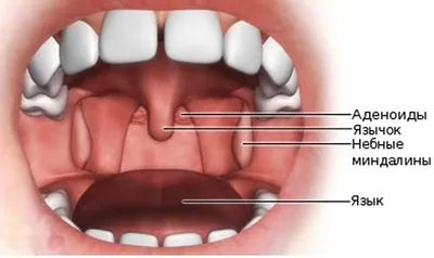 Тонзиллит острый и хронический: лечение тонзиллита у взрослого и ребенка