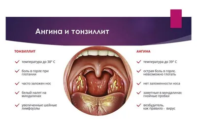 ЛОР clinic - ⁉️ГЛАНДЫ — это выросты тканей в задней части... | Facebook