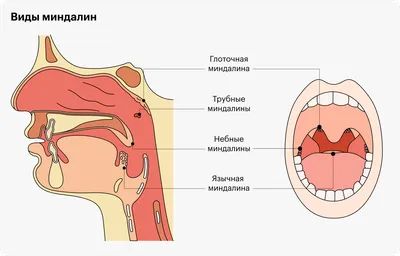 Гнойная ангина: типы, причины возникновения, симптомы, лечение заболевания