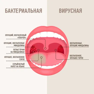 Гнойная ангина, чем лечить гнойную ангину, симптомы и признаки - блог  Furasol®