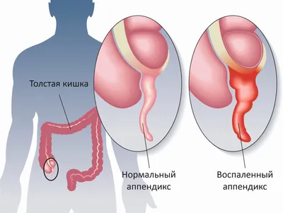 Где находится аппендицит у человека фото