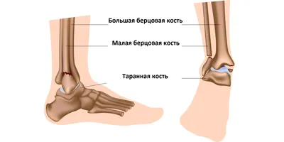 Где находится лодыжка у человека фото