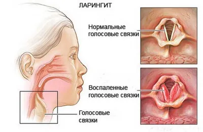 Паратонзиллярный абсцесс: причины, методы лечения, принципы профилактики |  ЛОР Кабинет