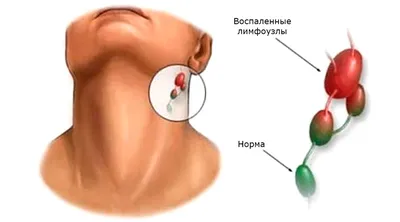 Гнойная ангина, горло изнутри» — создано в Шедевруме