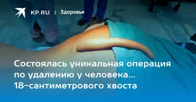 Состоялась уникальная операция по удалению у человека… 18-сантиметрового  хвоста - KP.RU