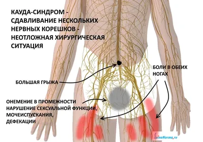 Cиндром конского хвоста позвоночника у человека при грыже: симптомы,  лечение, причины