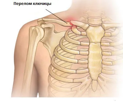 Что показывает рентген ключицы?