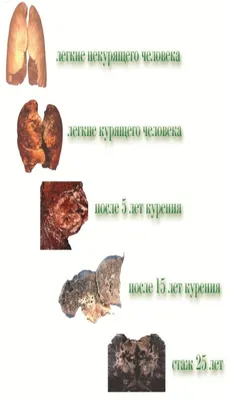 Легкие курящего и некурящего человека фото