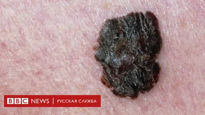 Меланома у собак: красивые и эмоциональные изображения