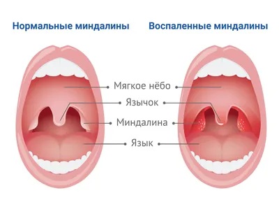 Миндалины здорового человека фото