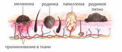 [87+] Полипы на теле человека фото фото