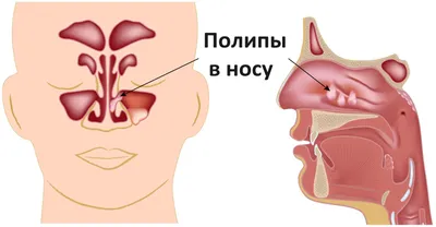 Глисты у детей. Как выявить и надо ли лечить? - FxMed - ЦЕНТР МОЛЕКУЛЯРНОЇ  АЛЕРГОЛОГІЇ