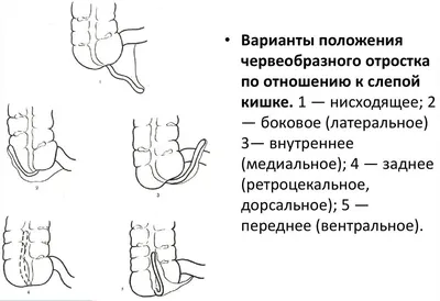 Первые симптомы аппендицита: ранние признаки опасного заболевания - 4 июня  2023 - ФОНТАНКА.ру