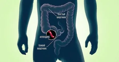 Аппендицит: симптомы, признаки, с какой стороны болит, операция по  удалению, как определить