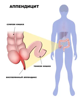 Аппендицит - причины появления, симптомы заболевания, диагностика и способы  лечения