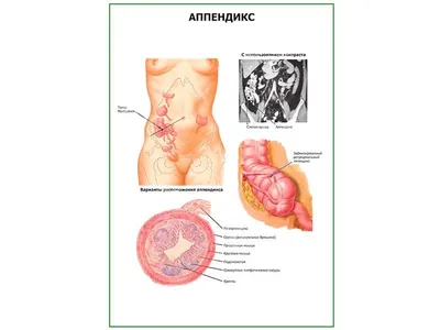 Острый аппендицит - симптомы и причины заболевания, классификация и  диагностика