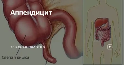 U Clinic - Аппендицит Аппендикс — червеобразный отросток... | Facebook