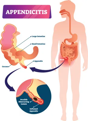Аппендицит: симптомы у взрослых и детей | Диагностика и лечение аппендицита  в АО «Медицина»