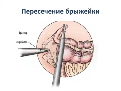 Что такое аппендикс, где он находится и зачем нужен - Лайфхакер