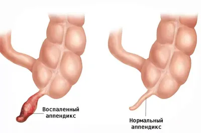 Острый аппендицит: симптомы, диагностика и лечение в Москве — цены и запись  на диагностику онлайн в Европейском Медицинском Центре EMC