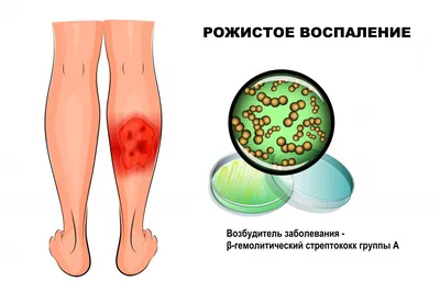 Рожа у человека фото