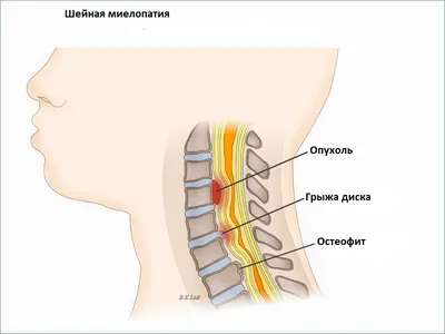 Сирингомиелия (болезнь Морвана, спинальный глиоз) - симптомы острой и  хронической форм, стадии и признаки у мужчин и женщин, причины появления,  диагностика и лечение заболевания