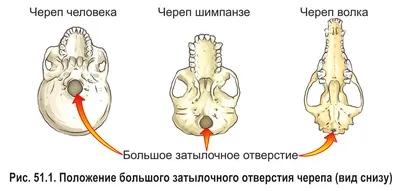 Сравнение Искажений Таза Обычный Таз Искажённый Таз Твистед Пэлвис  Известный Векторное изображение ©Sakurra 575453306