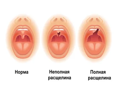 Волчья пасть у человека фото