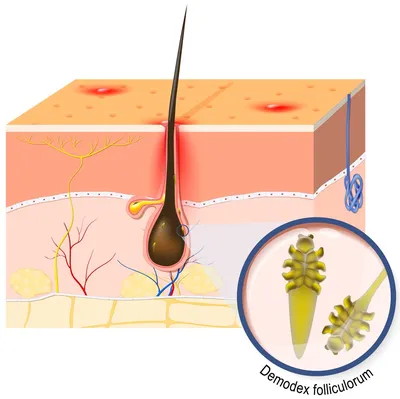 Волосяной клещ у человека фото