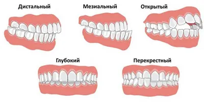 Химическое отбеливание зубов — цены, описание, фото и отзывы в Москве